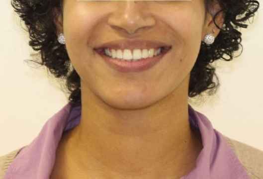 Исправление прикуса пациент Глория, Ортодонт Москва