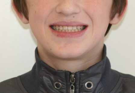 Исправление мезиальной окклюзии пациент Абукар, Ортодонт Москва