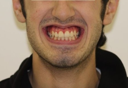 Исправление сужения зубных рядов пациент Артем, Ортодонт Москва