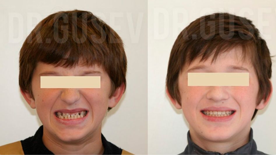 Лечение на брекет-системе