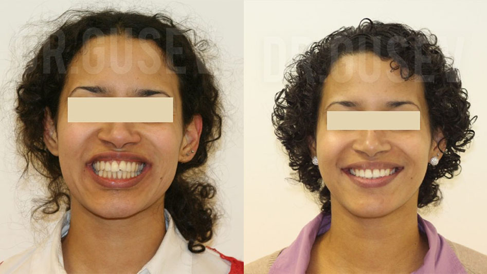 Лечение на брекет-системе