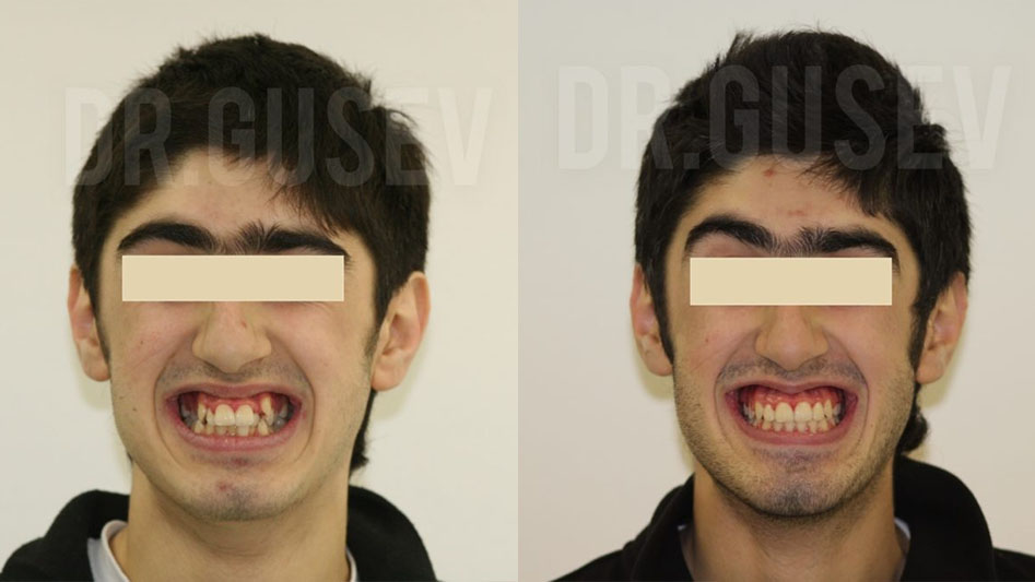 Лечение на брекет-системе